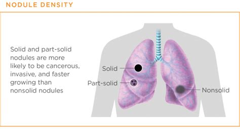 suspicious densities in both upper lobes|When to Worry About Lung Nodules or a Spot on the Lungs.